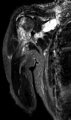 Figure 5 for case amyloid arthropathy ( RID5188 )